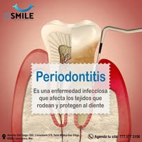 Periodontitis ID Smile